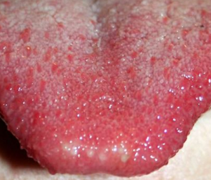 Bumps On the Back of My Tongue